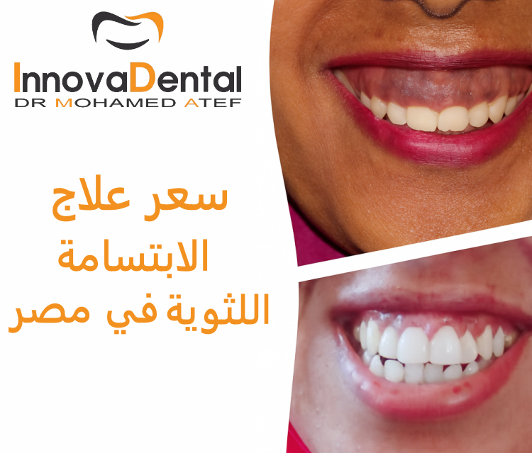 Gummy smile treatment price in Egypt